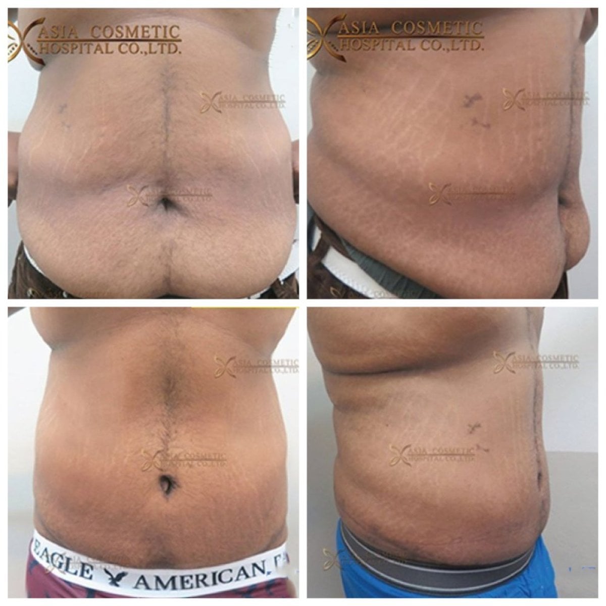 نتائج شفط الدهون قبل وبعد في Asia Cosmetic Hospital، تقليل واضح لدهون البطن