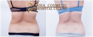 Before and after liposuction results at Asia Cosmetic Hospital, visible waist contour improvement
