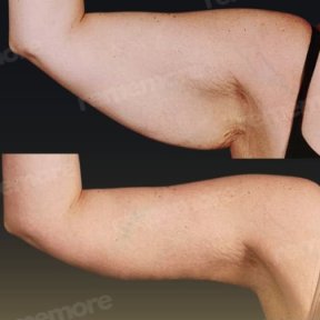 Vorher-nachher-Ergebnis Armlifting bei Memorial Bahçelievler Hospital, verbesserte Kontur