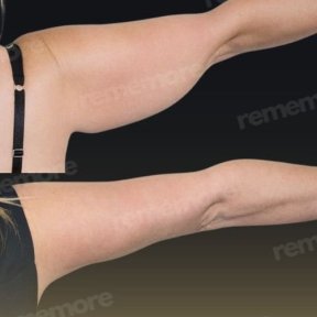 Vorher-nachher-Ergebnis der Oberarmstraffung im Memorial Bahçelievler Hospital, Brachioplastik