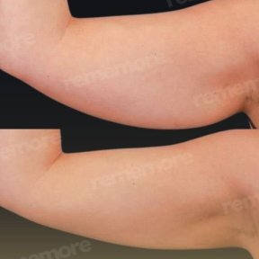 Vorher-nachher-Ergebnis Armlifting bei Memorial Bahçelievler Hospital, Brachioplastik