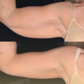 Vorher-nachher-Ergebnis Armlifting bei Memorial Bahçelievler Hospital, straffere Arme