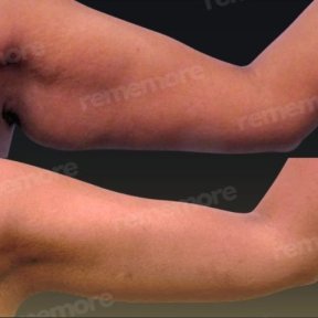 Vorher-nachher-Ergebnis Armlifting bei Memorial Bahçelievler Hospital, verbesserte Kontur