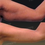 Vorher-nachher-Ergebnis Armlifting bei Memorial Bahçelievler Hospital, verbesserte Kontur
