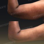 Vorher-nachher-Ergebnis Armlifting bei Memorial Bahçelievler Hospital, verbesserte Kontur