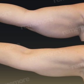 Vorher-nachher-Ergebnis der Oberarmstraffung in Memorial Bahçelievler Hospital, Brachioplastik