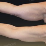 Vorher-nachher-Ergebnis der Oberarmstraffung in Memorial Bahçelievler Hospital, Brachioplastik