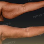 Vorher-nachher-Ergebnis der Oberarmstraffung in Memorial Bahçelievler Hospital, Brachioplastik