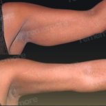 Vorher-nachher-Ergebnisse der Oberarmstraffung im Memorial Bahçelievler Hospital, Brachioplastik