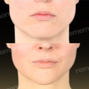 Facelift Vorher-Nachher-Ergebnis bei Memorial Bahçelievler Hospital, verbesserte Gesichtskontur