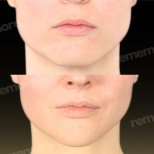 Facelift Vorher-Nachher-Ergebnis bei Memorial Bahçelievler Hospital, verbesserte Gesichtskontur