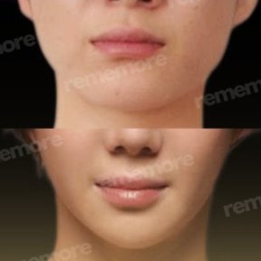 Facelift Vorher-Nachher-Ergebnisse im Memorial Bahçelievler Hospital, sichtbare Verjüngung