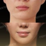 Facelift Vorher-Nachher-Ergebnisse im Memorial Bahçelievler Hospital, sichtbare Verjüngung