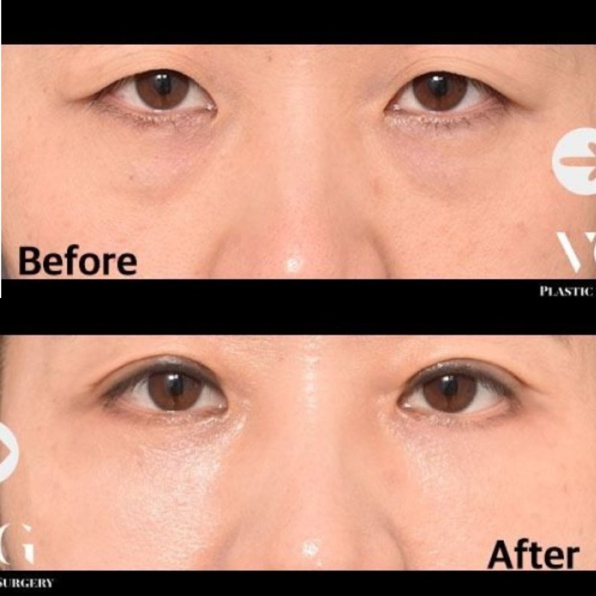 نتائج جراحة الجفون العلوية والسفلية قبل وبعد في عيادة VG Plastic Surgery