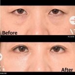 Before and after upper and lower eyelid surgery results at VG Plastic Surgery clinic