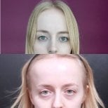 Before and after upper and lower eyelid surgery results at VG Plastic Surgery clinic