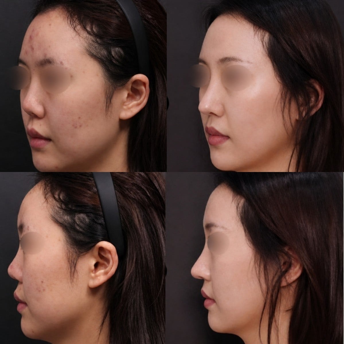 نتائج قبل وبعد عملية تجميل الأنف التصحيحية في VG Plastic Surgery، تحسين شكل الأنف