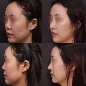 Before and after revision rhinoplasty results at VG Plastic Surgery, improved nose contour