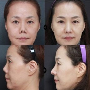 Before and after revision rhinoplasty results at VG Plastic Surgery, improved nose contour