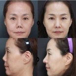 Before and after revision rhinoplasty results at VG Plastic Surgery, improved nose contour