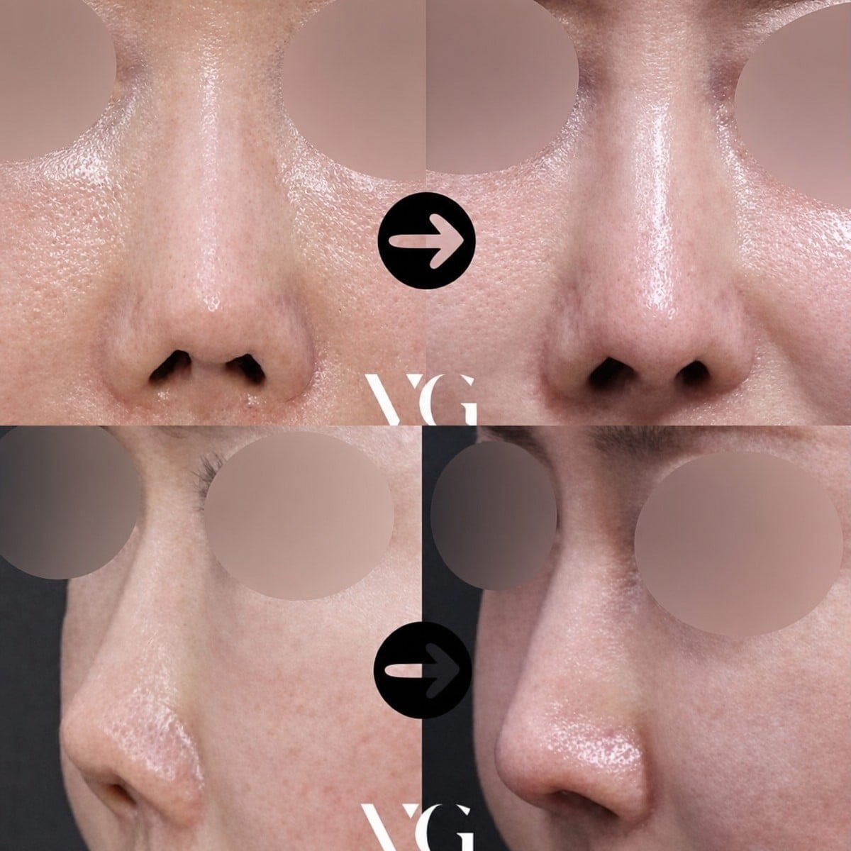نتائج قبل وبعد عملية تجميل الأنف التصحيحية في VG Plastic Surgery، شكل أنف محسّن