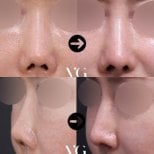 Before and after revision rhinoplasty results at VG Plastic Surgery, improved nose shape