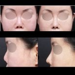 Before and after revision rhinoplasty results at VG Plastic Surgery, improved nose contour