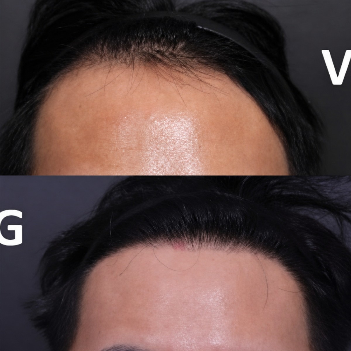 Resultados de trasplante capilar antes y después en VG Plastic Surgery – línea capilar restaurada