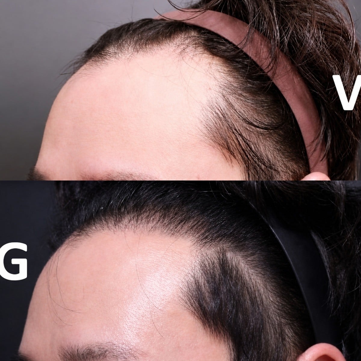 Resultado de trasplante capilar antes y después en VG Plastic Surgery – línea capilar restaurada