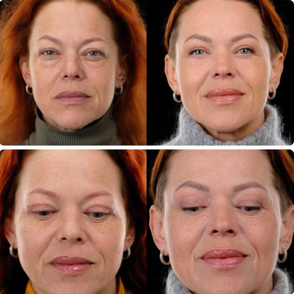 Resultados de blefaroplastia antes y después en Yurchenko Plastic Surgery Team Kyiv, corrección de párpados