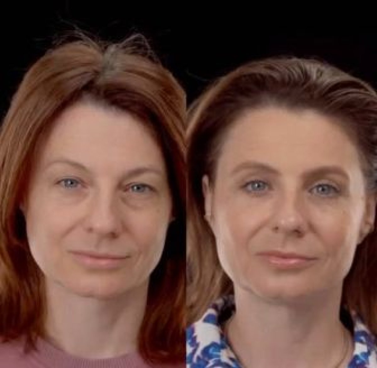 Blefaroplastyka przed i po w Yurchenko Plastic Surgery Team Kyiv, korekcja powiek