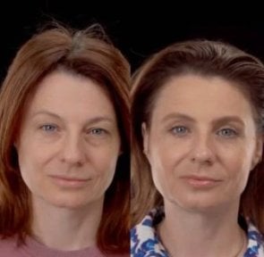 Resultados de blefaroplastia antes y después en Yurchenko Plastic Surgery Team Kyiv, corrección de párpados