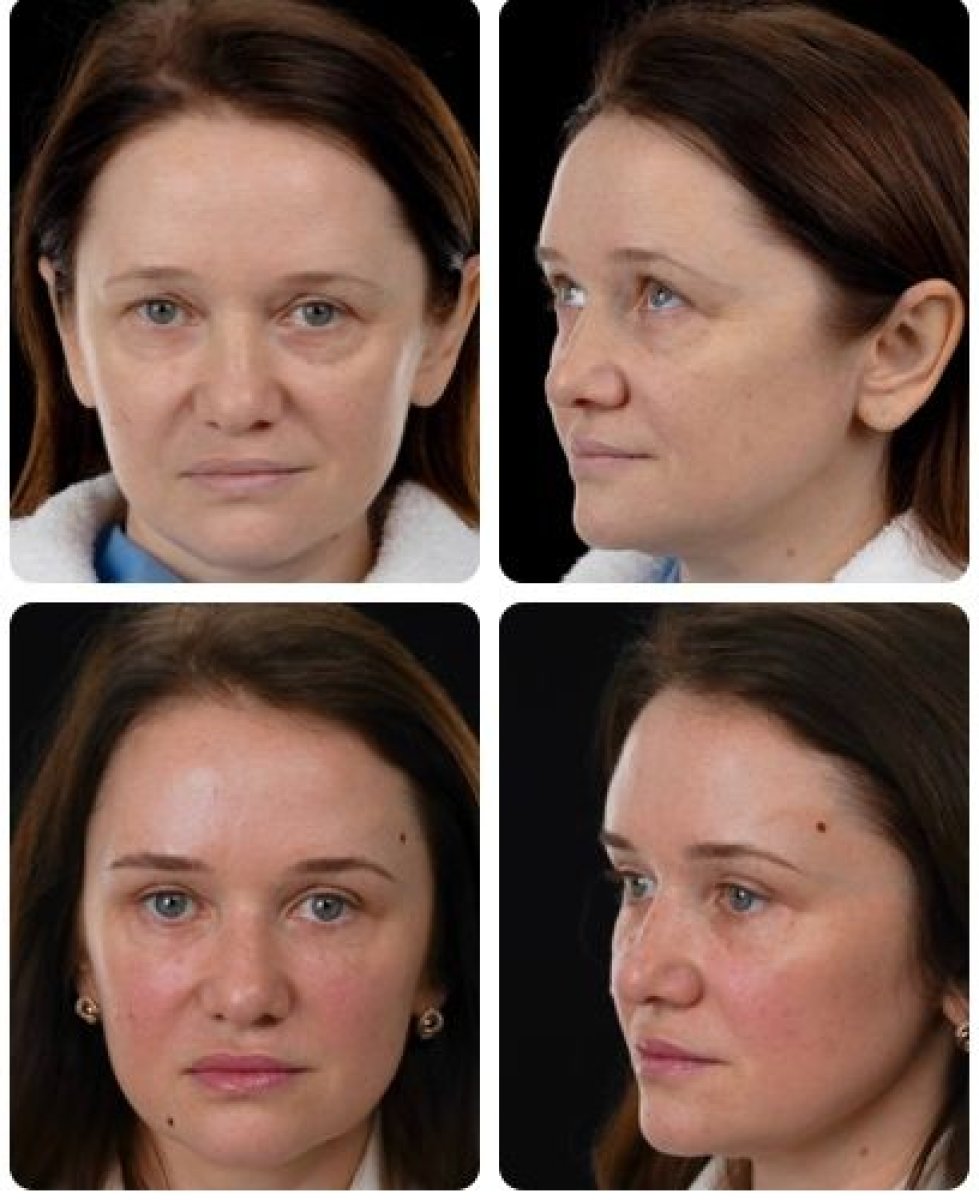 Blefaroplastyka przed i po w Yurchenko Plastic Surgery Team Kyiv, korekcja powiek