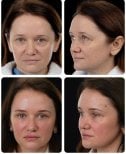 Resultados de blefaroplastia antes y después en Yurchenko Plastic Surgery Team Kyiv, corrección de párpados