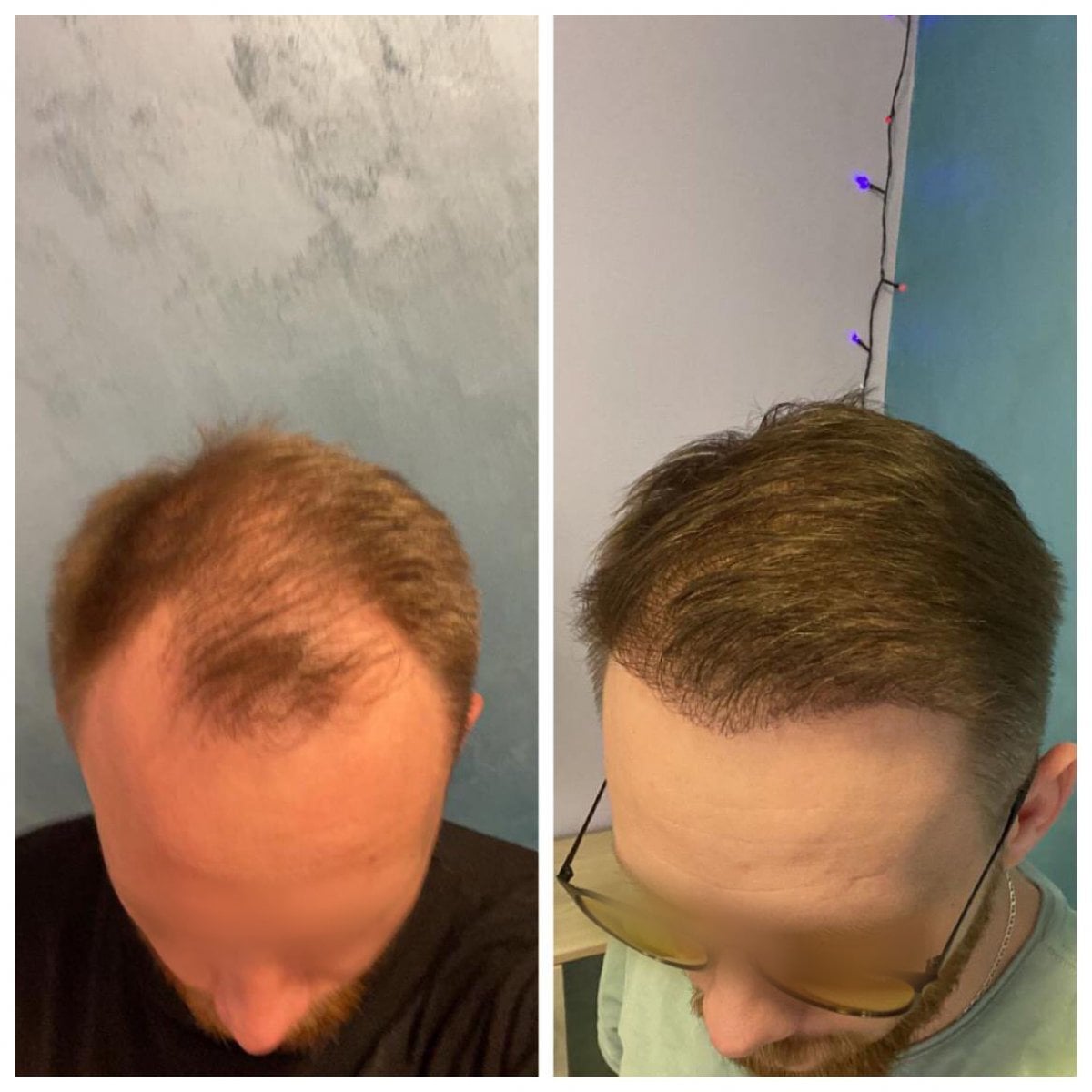 Resultados antes y después de trasplante capilar FUE en Adem and Havva Medical Center, línea restaurada