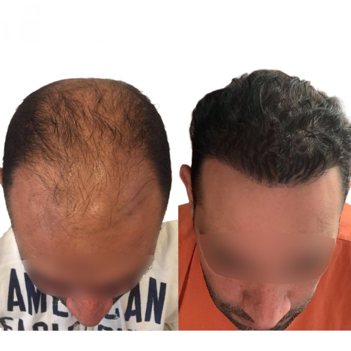 Before and after FUE hair transplant results at Adem and Havva Medical Center, restored hairline