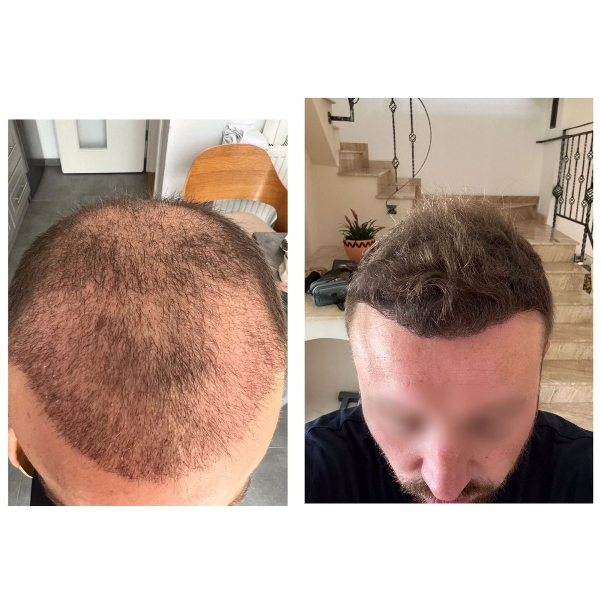 Before and after FUE hair transplant results at Adem and Havva Medical Center, improved hairline