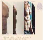 Before and after Vaser liposuction six pack results at Dr. MED, defined abs contour