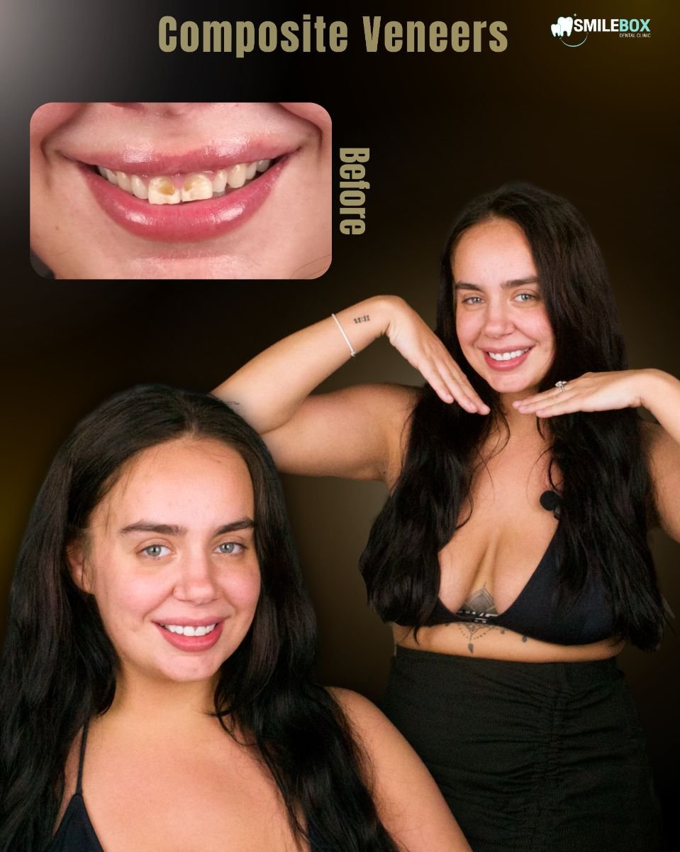 نتيجة قبل وبعد الفينير المركب في SmileBox Dental Clinic - Thonglor، تجميل الابتسامة