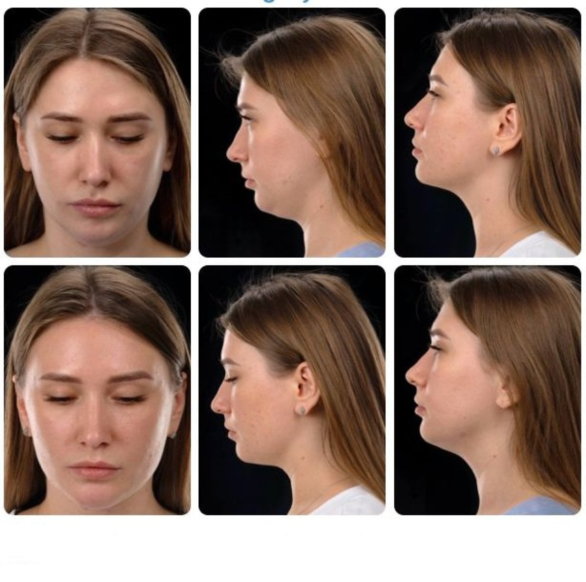 نتائج شفط الدهون Body Jet للذقن قبل وبعد في Yurchenko Plastic Surgery Team