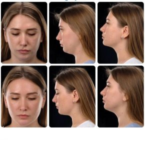 Before and after Body Jet liposuction results at Yurchenko Plastic Surgery Team, chin contouring