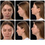 Before and after Body Jet liposuction results at Yurchenko Plastic Surgery Team, chin contouring