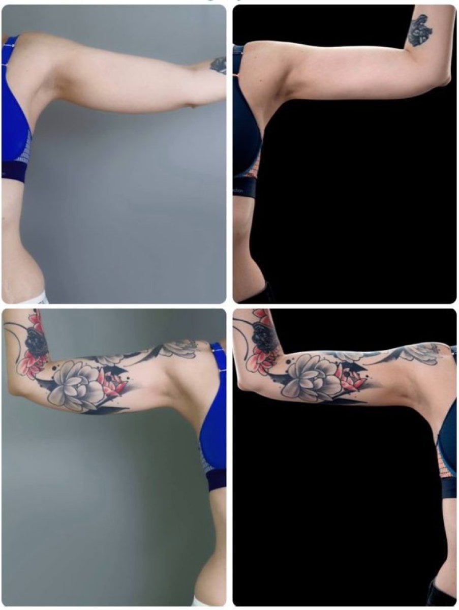 Resultados antes y después de liposucción Body Jet en brazos en Yurchenko Plastic Surgery Team