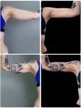 Before and after Body Jet liposuction results on arms at Yurchenko Plastic Surgery Team