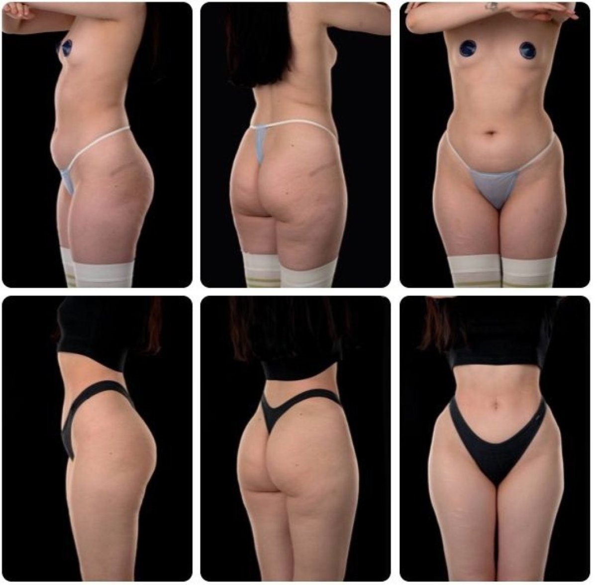 نتائج قبل وبعد شفط الدهون Body Jet في Yurchenko Plastic Surgery Team، نحت الجسم