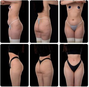 Before and after Body Jet liposuction results at Yurchenko Plastic Surgery Team, body contouring