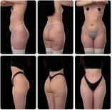 Before and after Body Jet liposuction results at Yurchenko Plastic Surgery Team, body contouring