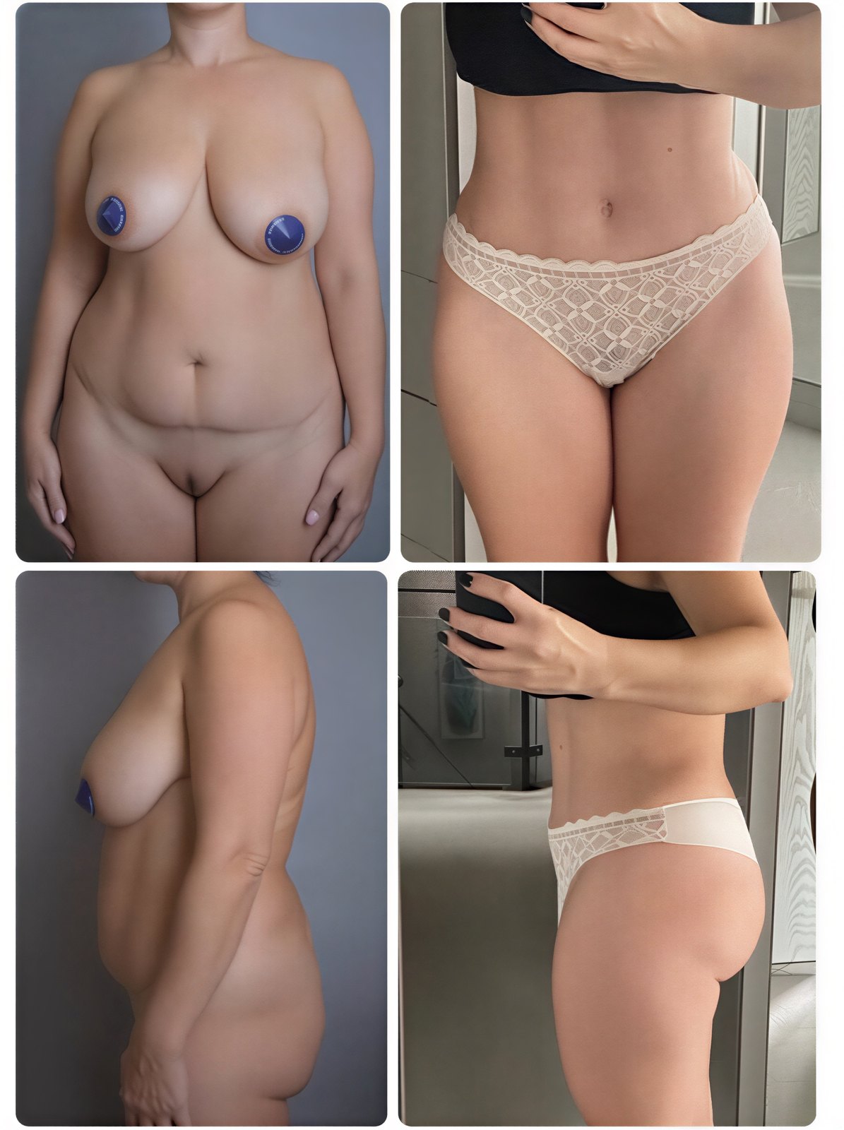 Resultados antes y después de liposucción Body Jet en Yurchenko Plastic Surgery Team, contorno corporal