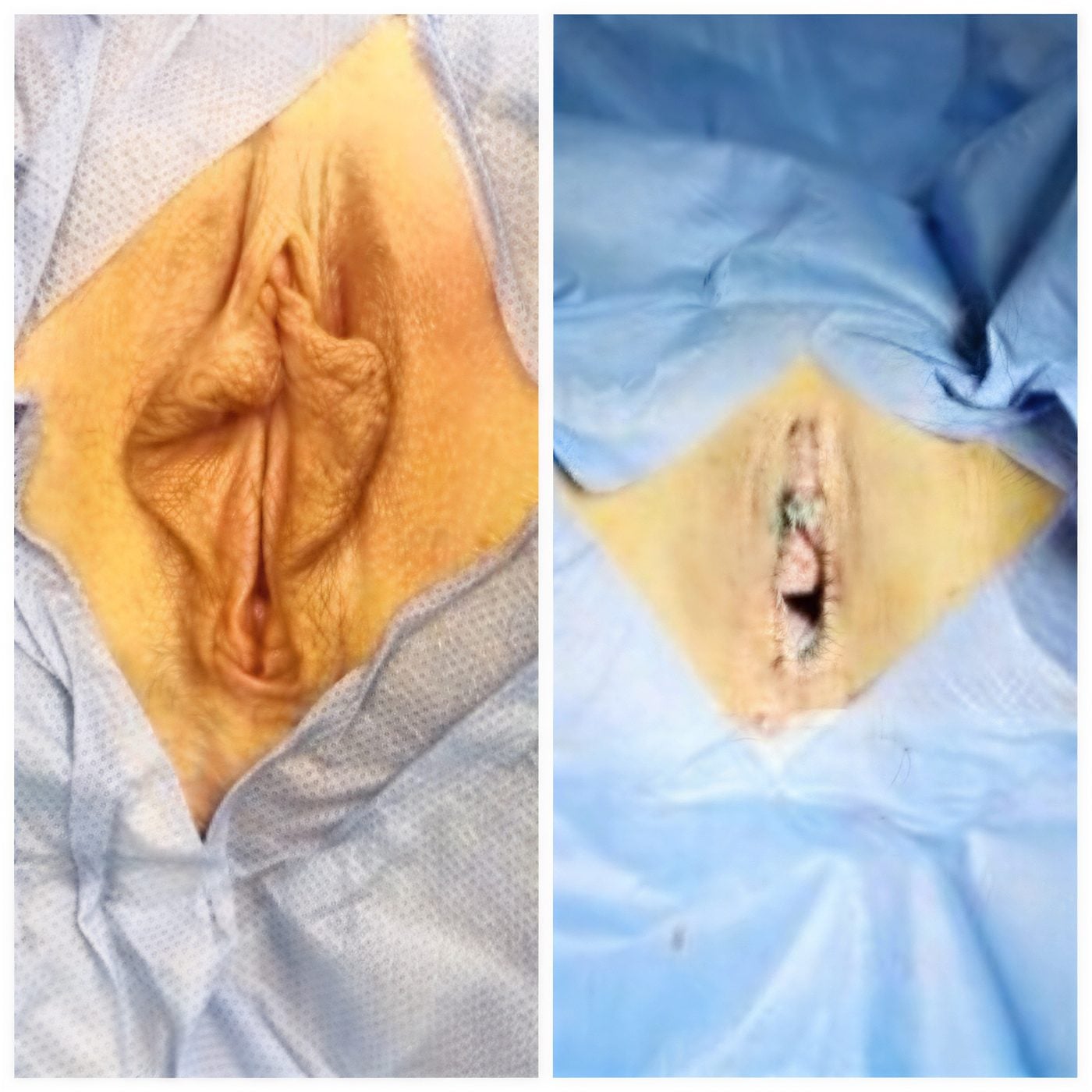 نتائج قبل وبعد عملية تجميل الشفرين في Yurchenko Plastic Surgery Team Kyiv، تصغير الشفرين