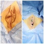 نتائج قبل وبعد عملية تجميل الشفرين في Yurchenko Plastic Surgery Team Kyiv، تصغير الشفرين